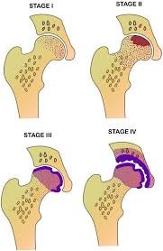 stages of avn